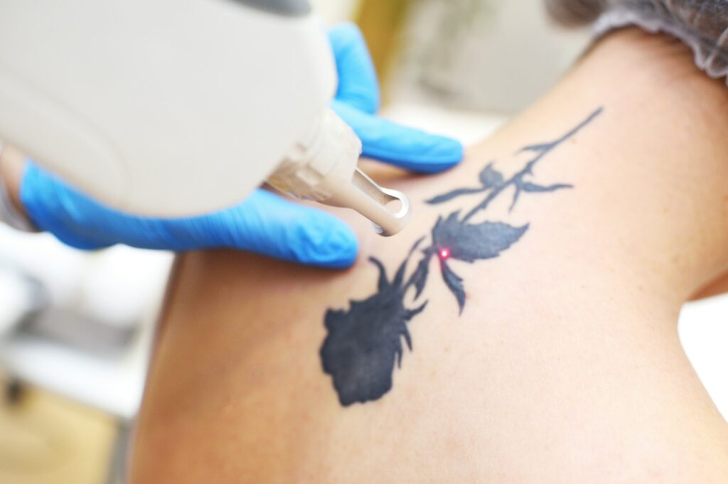 cosmetologist removes the tattoo to the patient using a neodymium laser in a modern clinic. Hardware